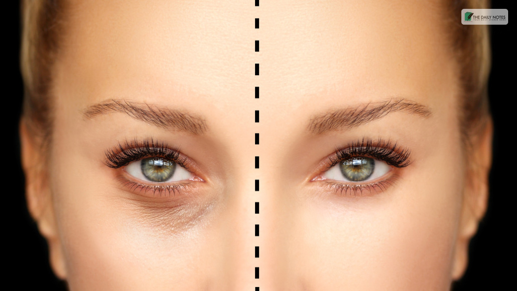 The Benefits and Limitations of Blepharoplasty