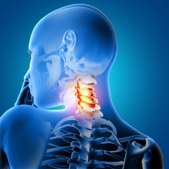 How to Have a Successful Treatment for Bulging Discs in Neck