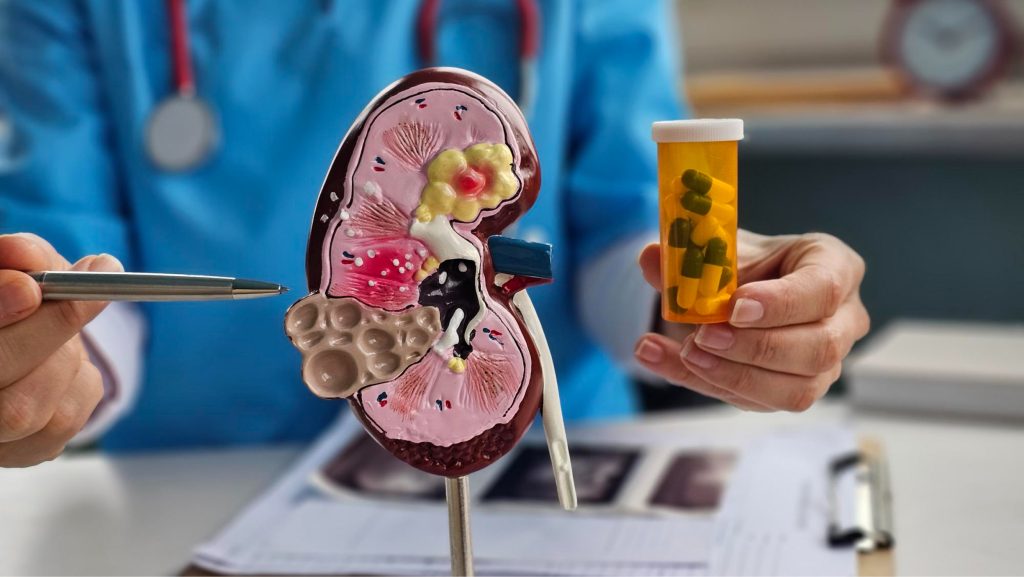 Understanding Kidney Stones