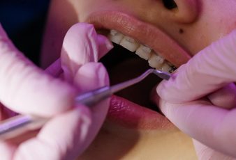 Braces Can Improve Your Oral Health