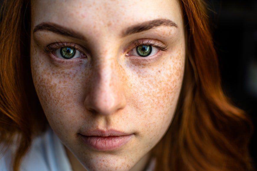 Common Causes of Acne