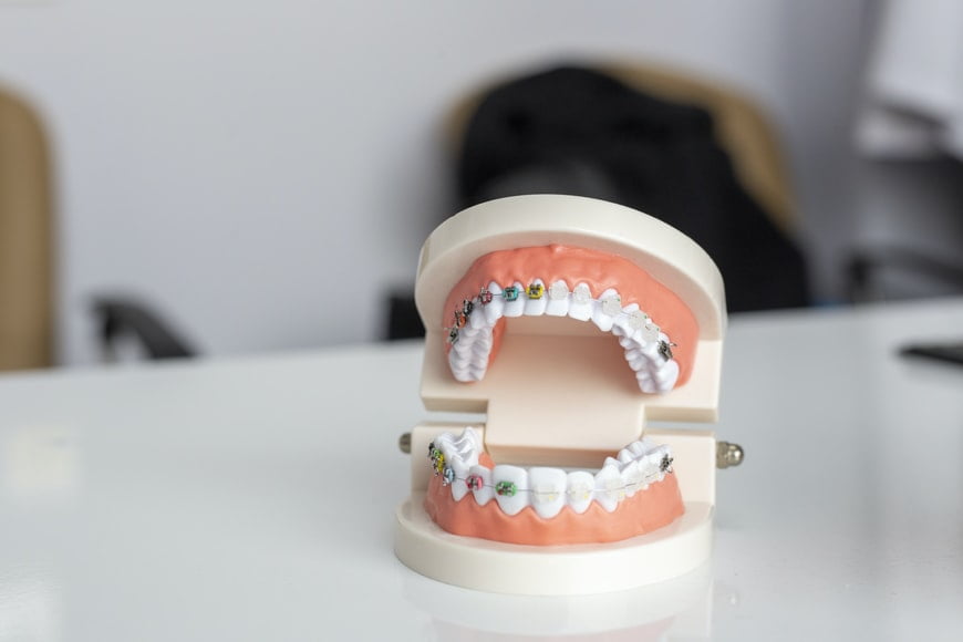 Benefits of Custom Teeth Grinding Guard