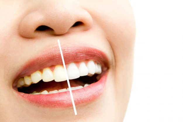 Professional VS. Over-The-Counter Whitening