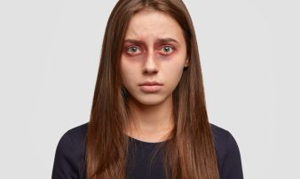Under-Eye Puffiness