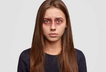 Under-Eye Puffiness